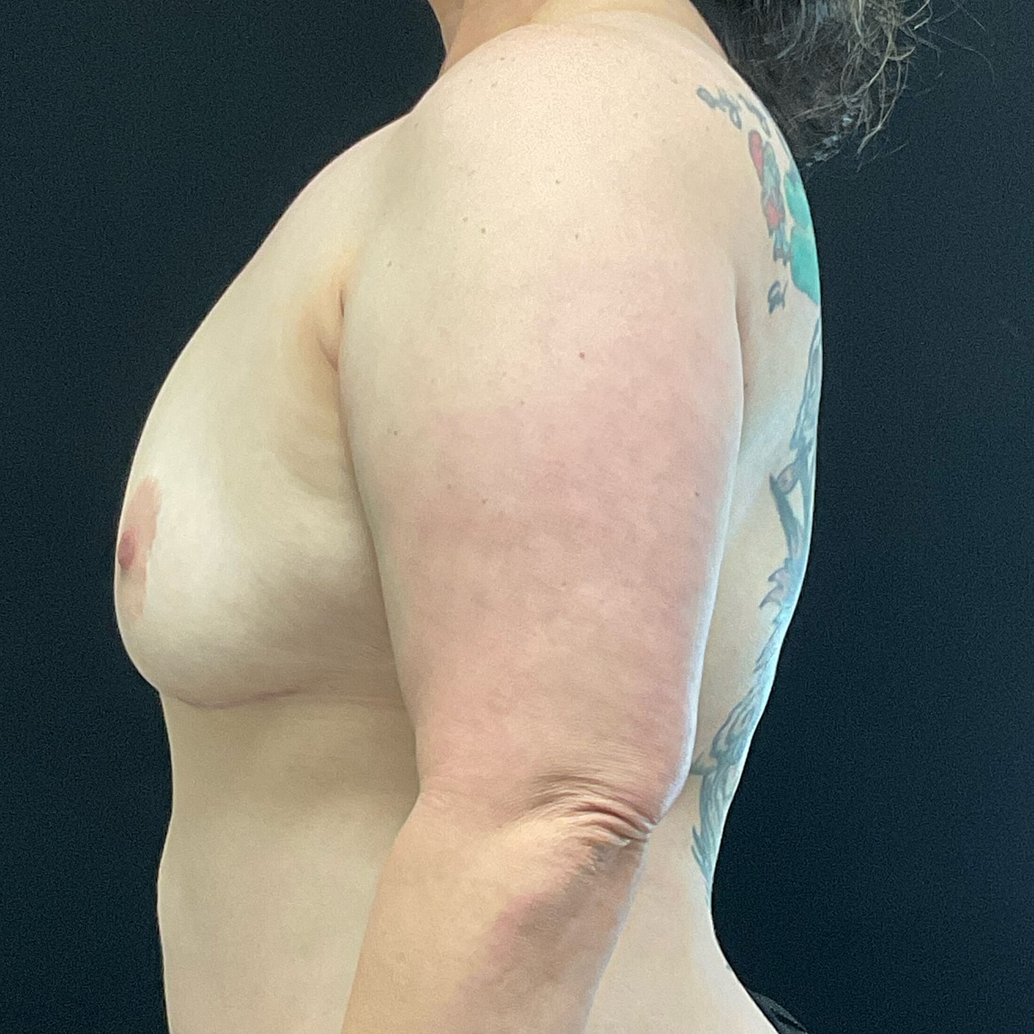 Breast Augmentation Fat Transfer Before & After