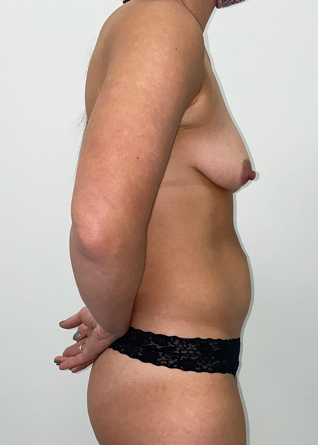 Breast Augmentation Fat Transfer Before & After