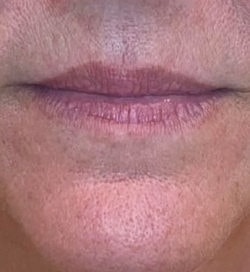 Lip Filler Before & After