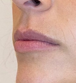 Lip Filler Before & After