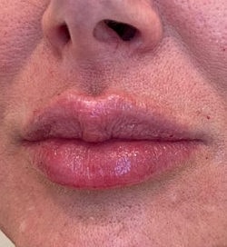 Lip Filler Before & After