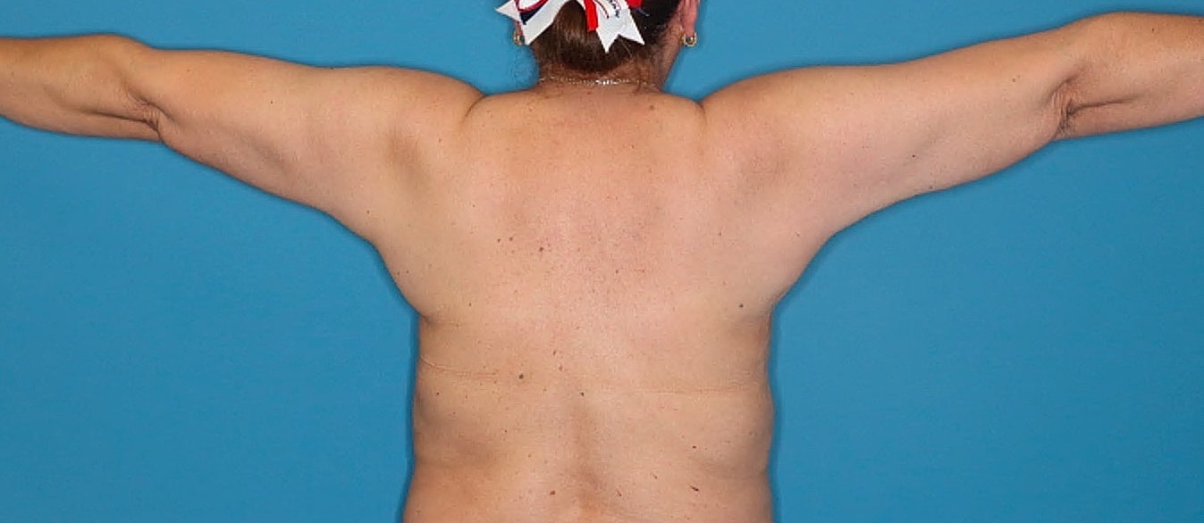 Liposuction- Arms Before & After
