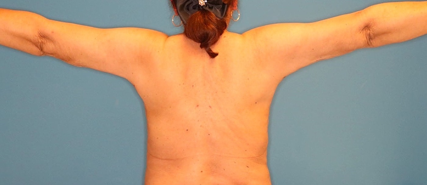 Liposuction- Arms Before & After
