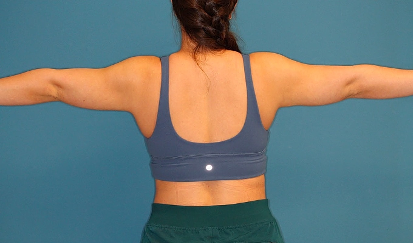 Liposuction- Arms Before & After