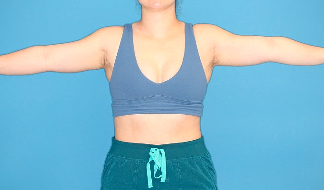 Liposuction- Arms Before & After