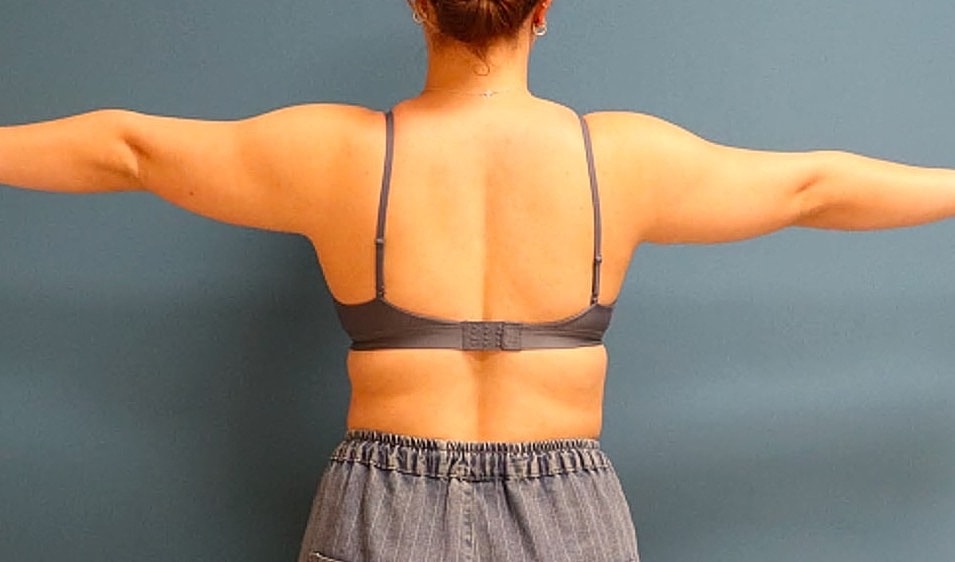 Liposuction- Arms Before & After