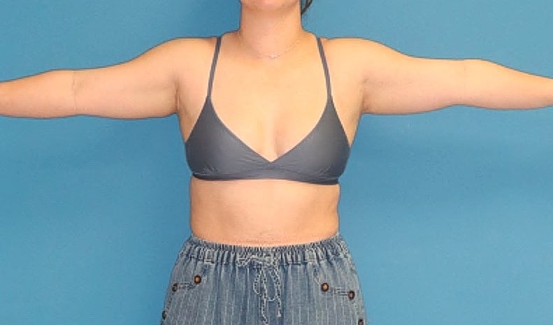Liposuction- Arms Before & After