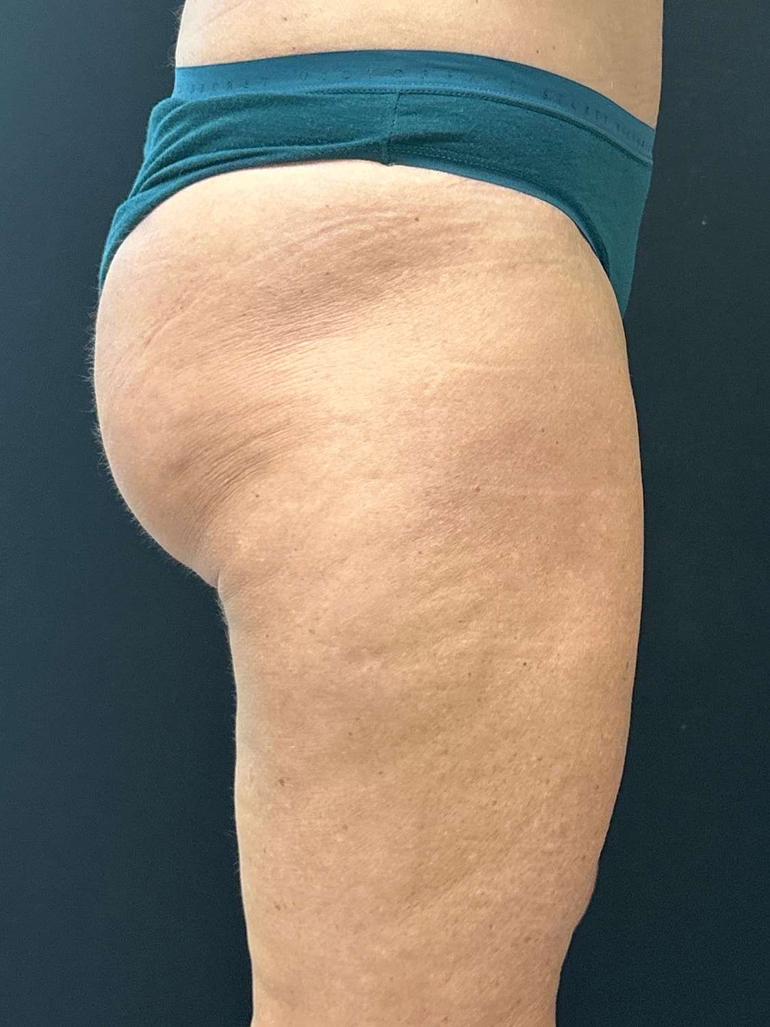 Aveli Cellulite Reduction Before & After