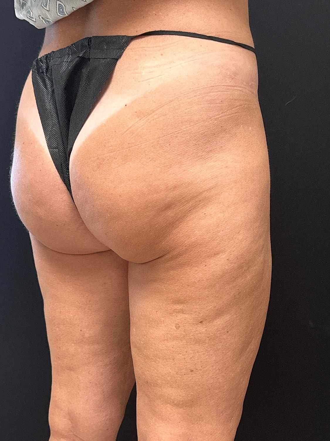 Aveli Cellulite Reduction Before & After