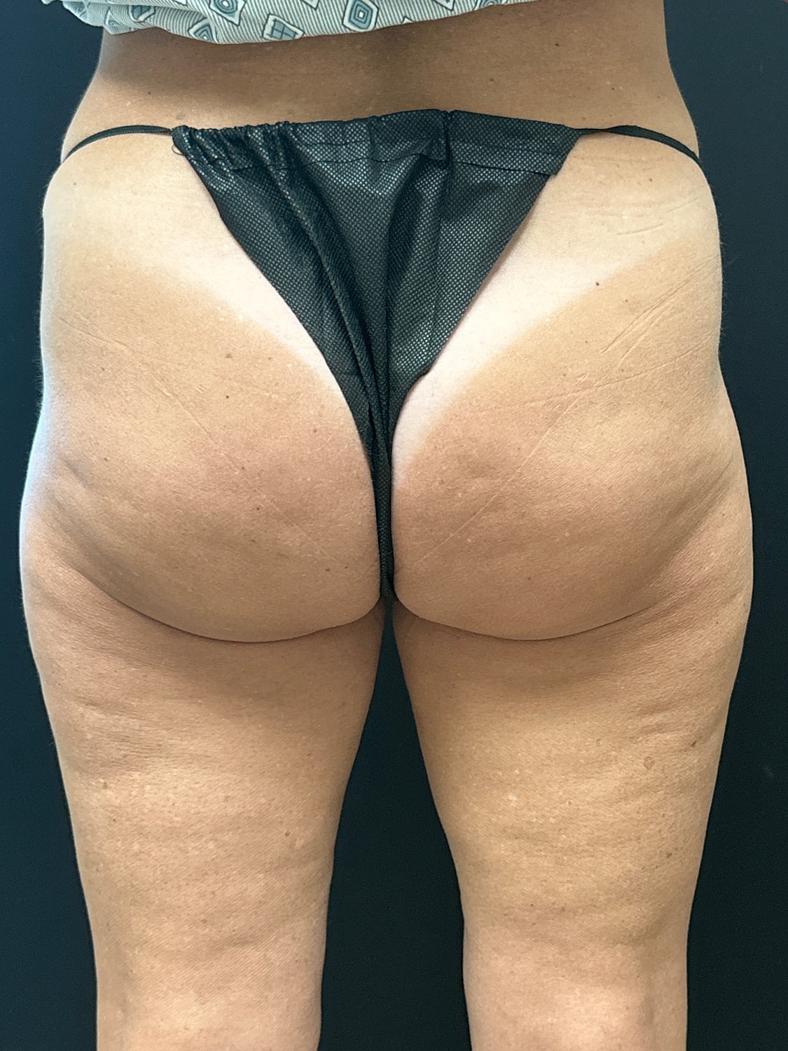 Aveli Cellulite Reduction Before & After