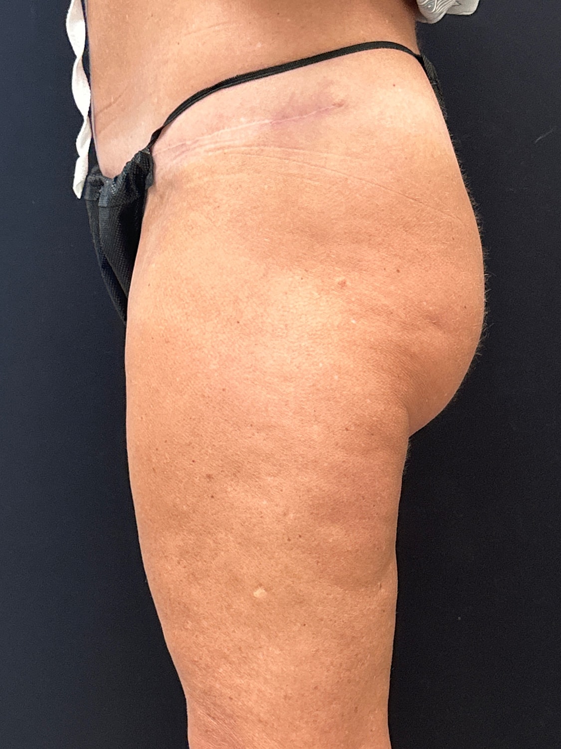 Aveli Cellulite Reduction Before & After