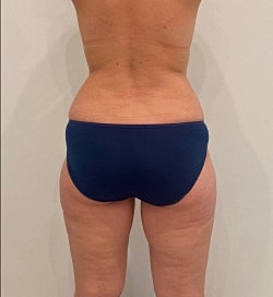 Liposuction Before & After