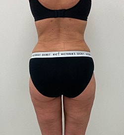 Liposuction Before & After