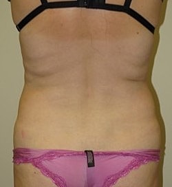 Liposuction Before & After