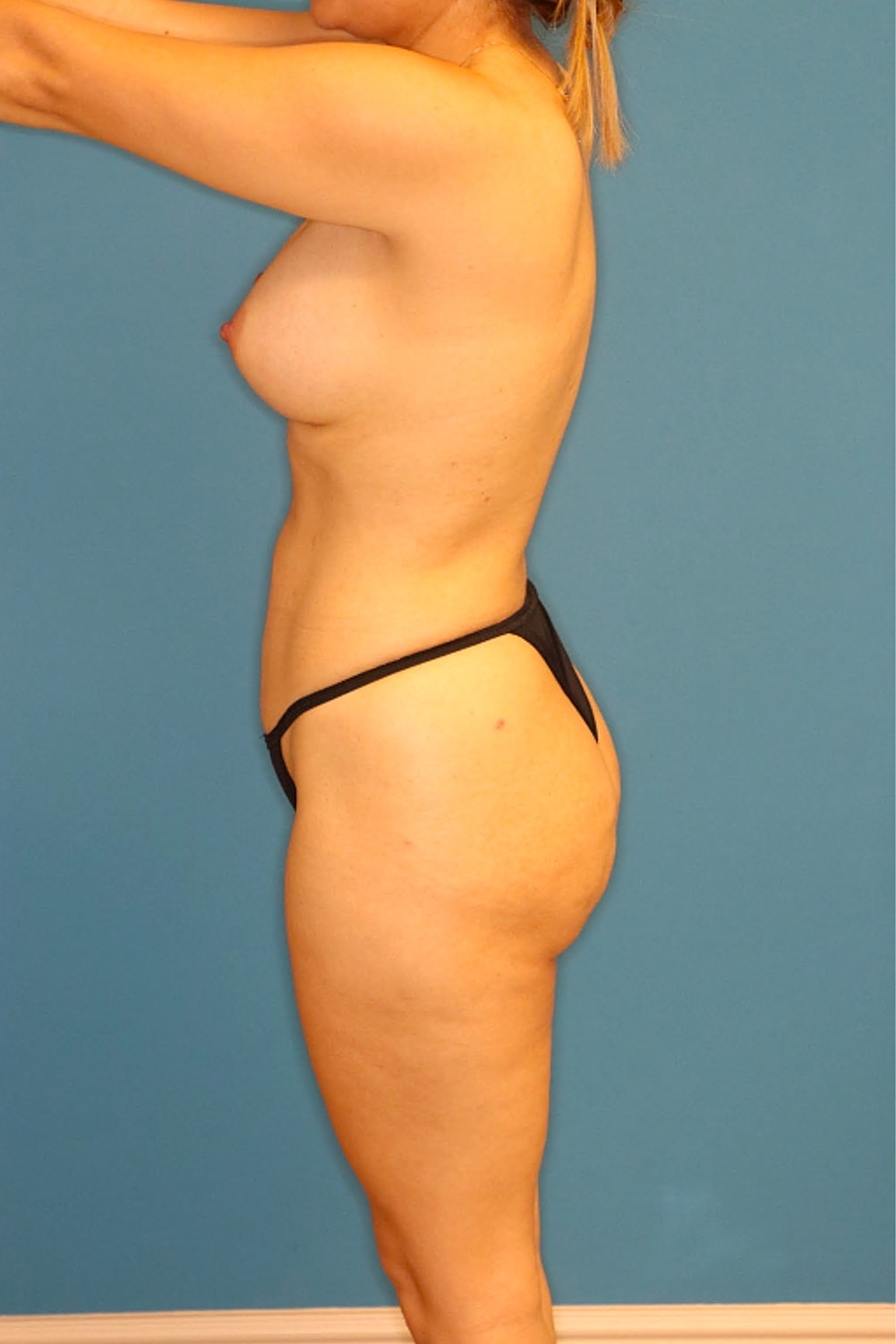 Liposuction Before & After